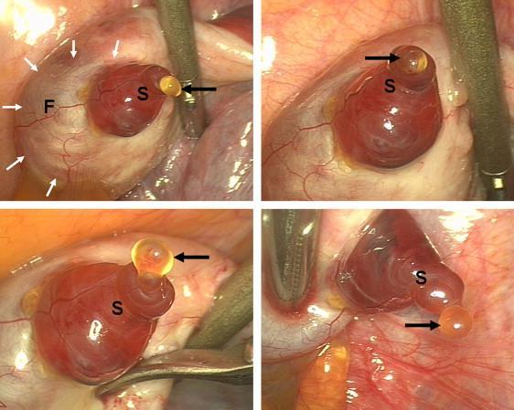 OVULÁCI CIÓ LAPAROSZKÓPOS POS KÉPEK 5 mm Figure 1 Laparoscopic observation of spontaneous human ovulation.