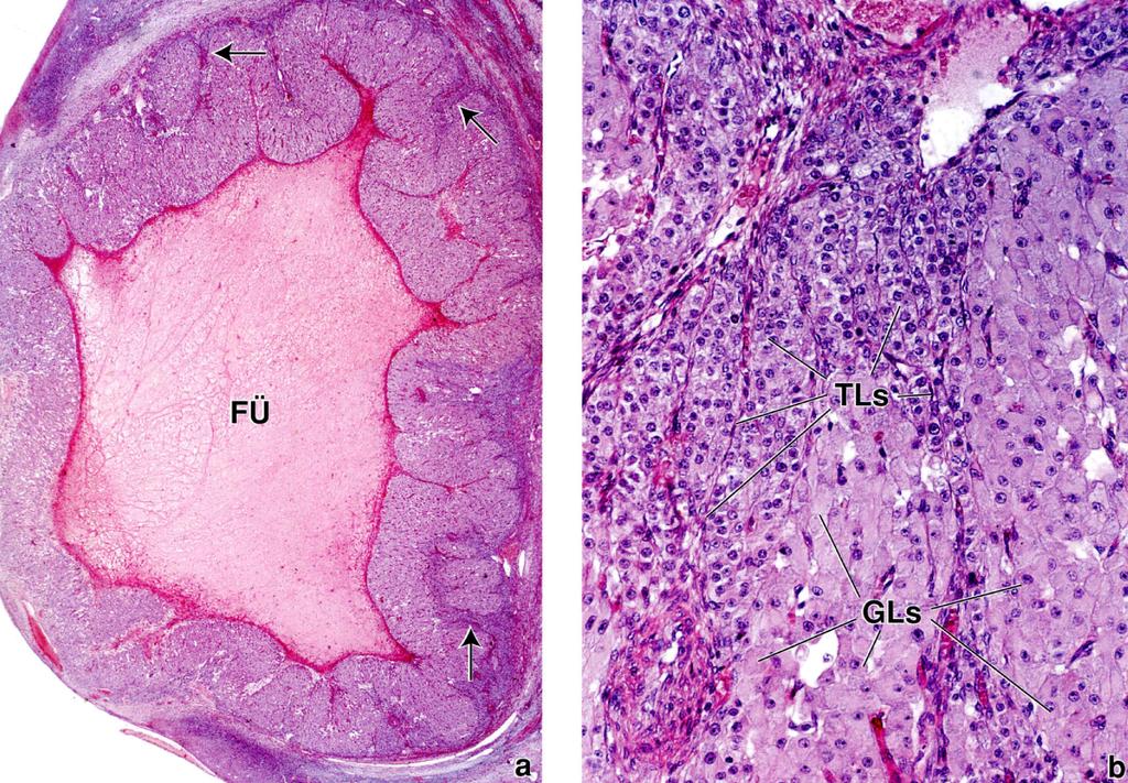 A corpus luteum kialakulása: a megrepedt Graaf-tüsző üregében (FÜ) bevérzés és fibrinháló keletkezik, melyet a gyorsan osztódó granulosa- és theca sejtek arra használnak, hogy