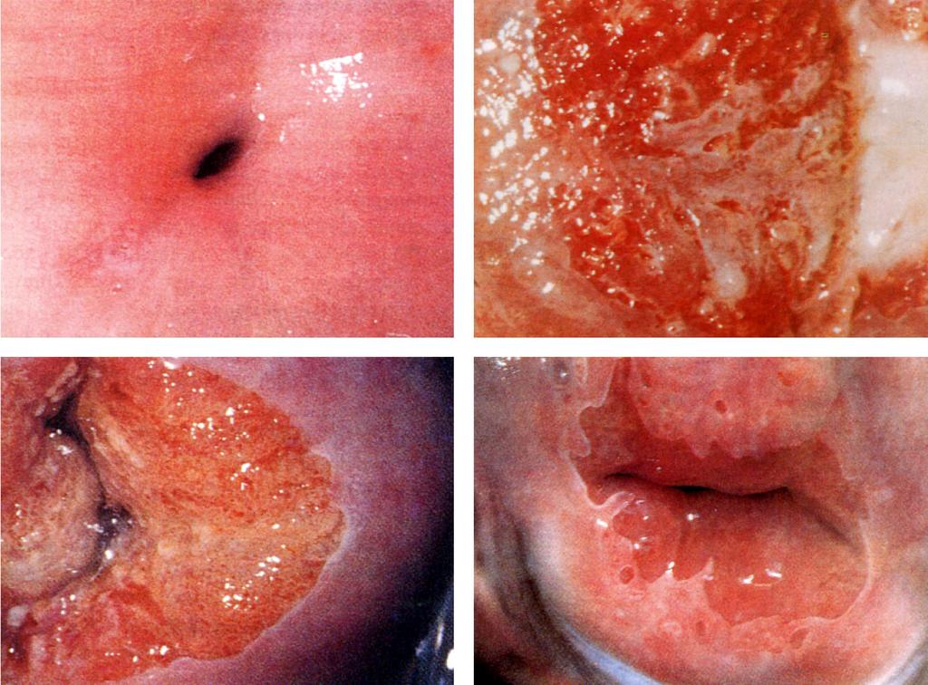 ÉP P HÁMH ECTOPIA, METAPLASIA ECTOPIA ECTOPIA PORTIO