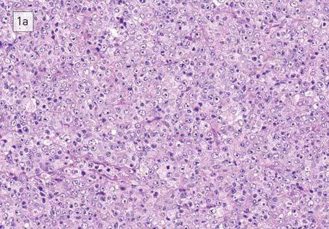 Bödör Cs, Gángó A, Schneider T Diffúz nagy B-sejtes lymphoma: úton a személyre szabott terápia felé 35 1. ábra. A diffúz nagy B-sejtes lymphoma morfológiai variánsai és immunhisztokémiai jellemzői 1a.