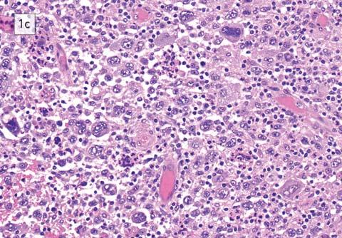 A sejtmembrán erős CD10-pozitivitása a centrum germinativum altípusú DLBCL-re jellemző; 1e. A tumorsejtek kifejezett MUM1-expressziója az aktivált B-sejtes eredetre utal. (A Semmelweis Egyetem I. sz.
