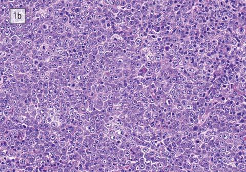 Az esetek 10%-ára jellemző CD5 expresszió de novo DLBCL-ben és krónikus lymphocytás leukaemia/kis lymphocytás lymphoma (CLL/SLL) Richter-transzformációjában is előfordulhat.