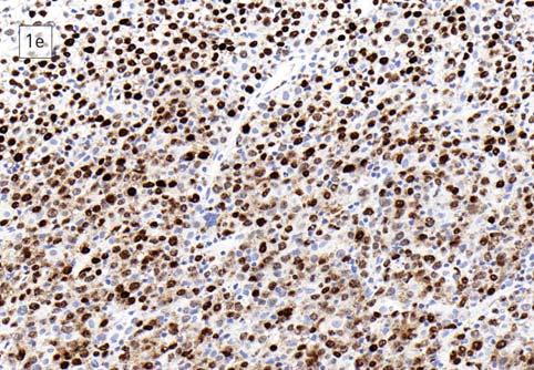 A szomatikus hipermutáción áteső centrum germinativum B-sejtekre jellemző expressziós profillal bír a centrum germinativum (GC)-DLBCL, míg a perifériás B- sejtek in vitro aktivációjára és plazmablast