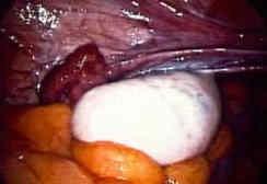 A polycystas ovarium