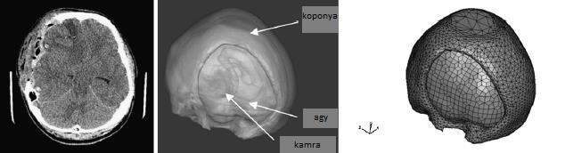 Kleiven, 2007; Post, 2014). Elsőként Chan Ping Gao és Beng Ti Ang közösen foglalkoztak a dekompresszív kraniektómia biomechanikai modellezésével traumás agysérülés esetén.