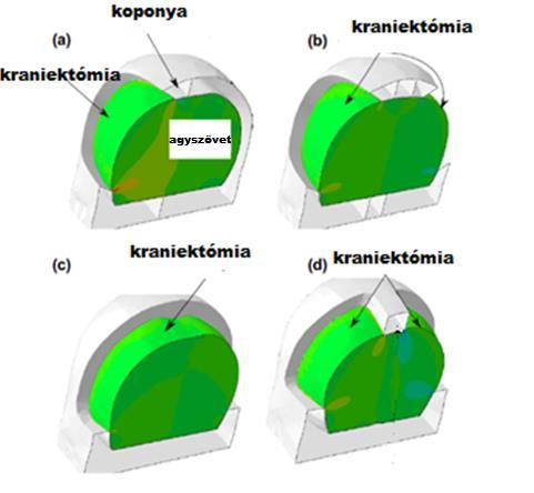 Az agyszövetre a modellben a térfogat növekedésének eléréseként különböző teherlépcsőkben hőmérsékleti terhet tettek, valamint súrlódásmentes kapcsolatot állítottak be a koponya és az agy között.