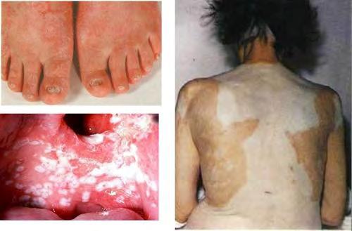 Centrális T sejt tolerancia defektusa: - Negatív szelekció zavara a thymusban: AIRE-APECED (polyendocrinopathia, ectodermális dystrophia,