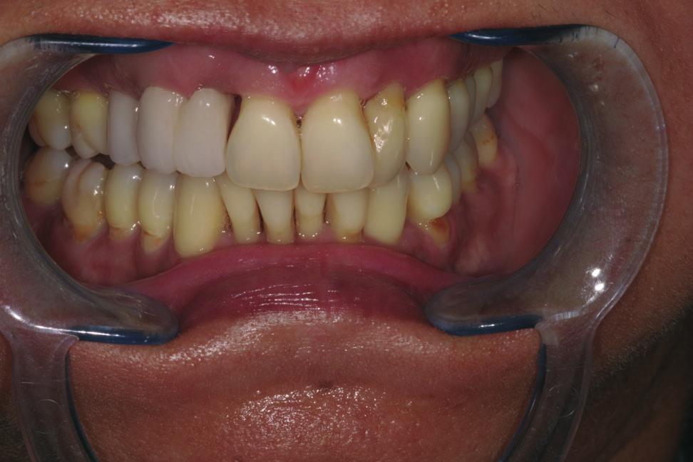 A jobb felső egyes és hármas fog közötti rövid meziodisztális távolság miatt a foghiány pótlása implantátummal nem volt lehetséges.