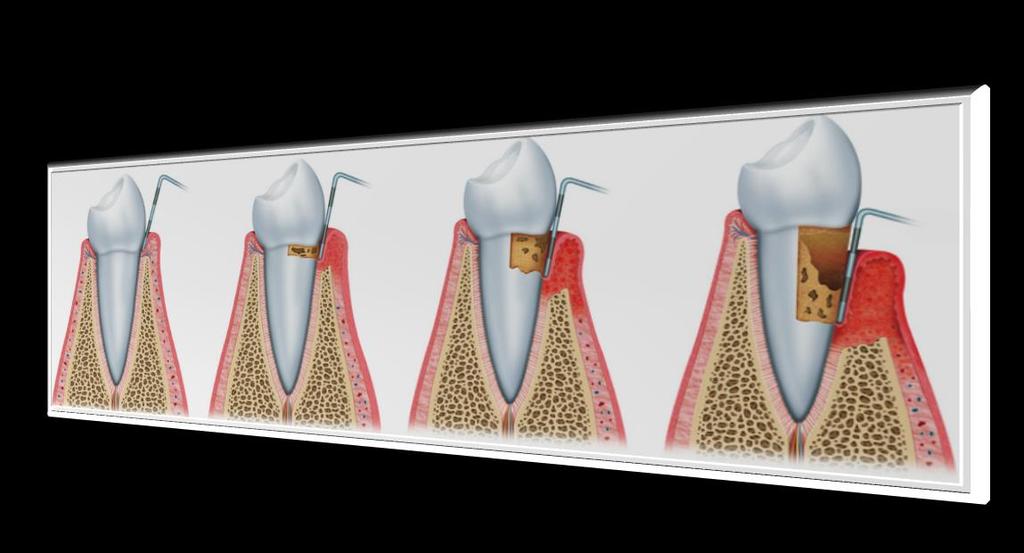 Gingivitis PARODONTITIS