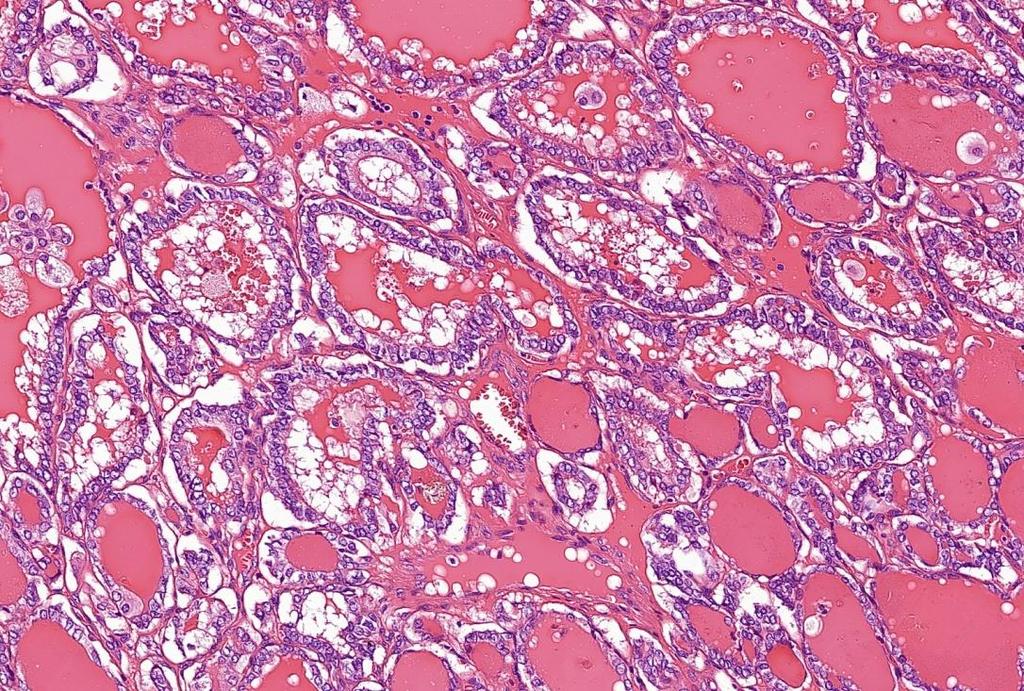 Papilláris carcinoma, folliculáris variáns