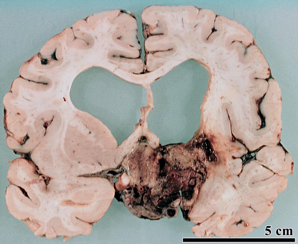 Hypophysis adenoma apoplexia Liquor stop liquornyomás