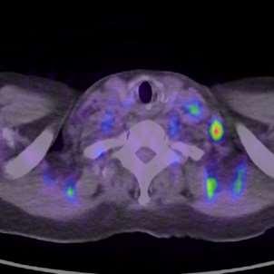 Adenocarcinoma