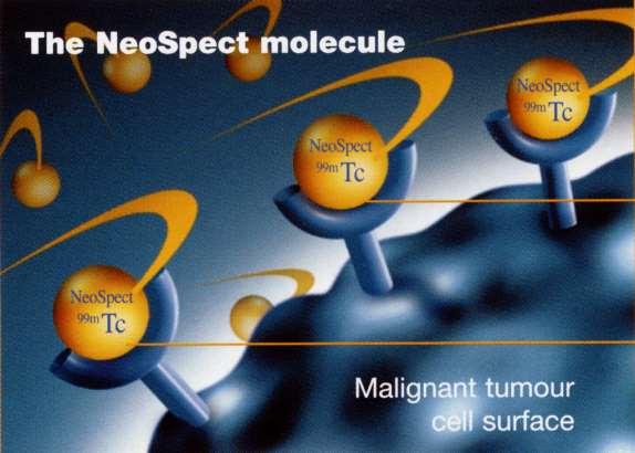 Receptor vizsgálatok tüdőtumorokban Elve: a tumorsejtek felszínén lévő somatostatin