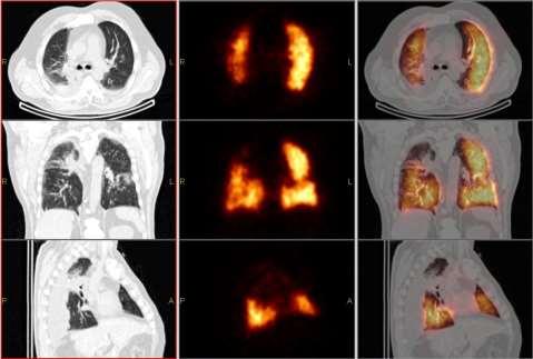 Tüdőtumor a jobb felső lebenyben, metastasis a
