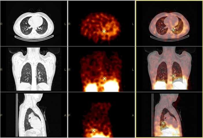 Pulmonális carcinoid