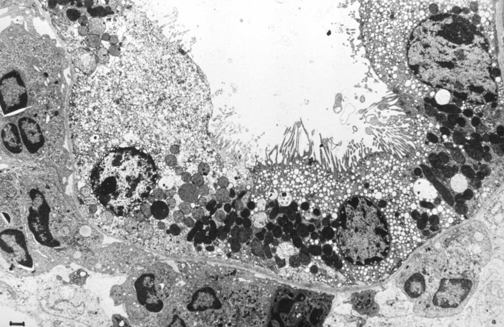 Elektronmikroszkópos kép: a vesecsatornahámsejtekben víz szaporodott fel a cytoplasmában, a felszíni membrán által képzett vacuolumokban
