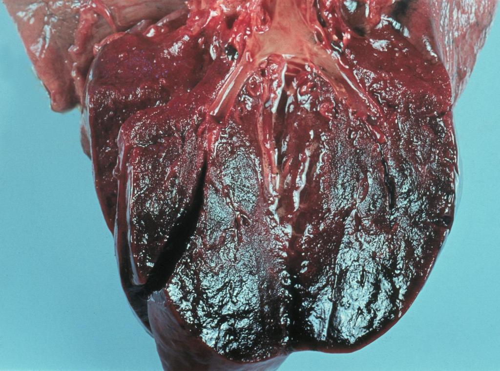 Vérzéses tüdőinfarctus: gúla alakú, alapjával a