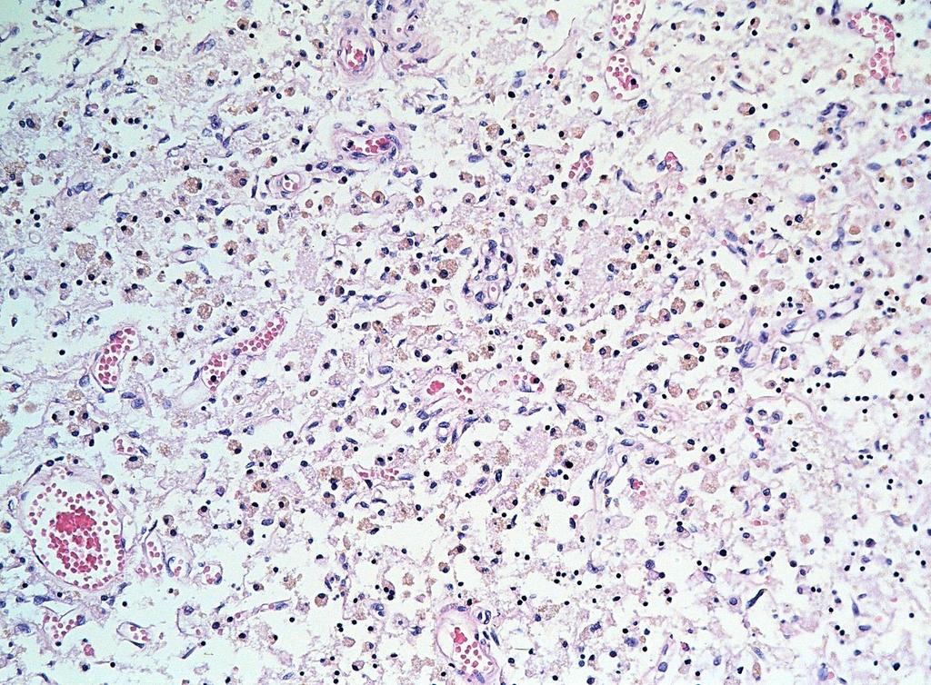 Infarctus cerebri FM képe: az elhalt területet macrophagok szűrik be, az elhalt