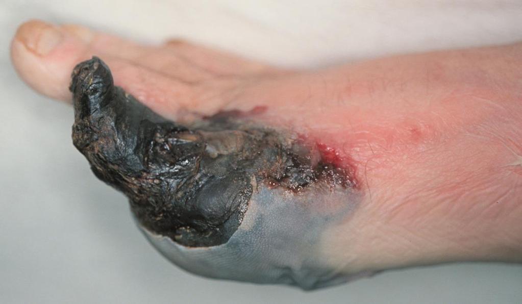 Gangraena sicca (száraz gangraena) A tibialis arteriát érelmeszesedés zárta el a lábujj