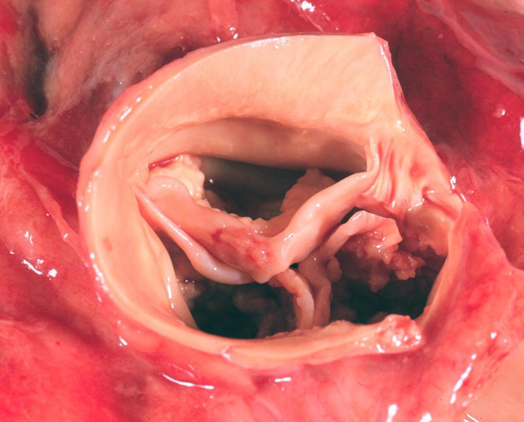 Dystrophiás meszesedés az aorta