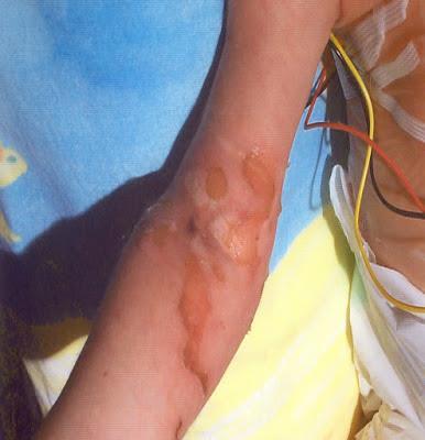 Neoadjuvs vagy