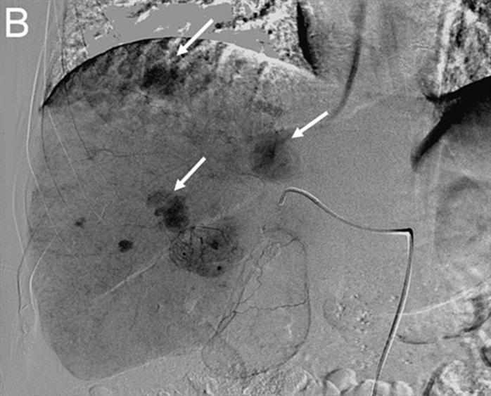 Palliativ, 1., 2., 3.