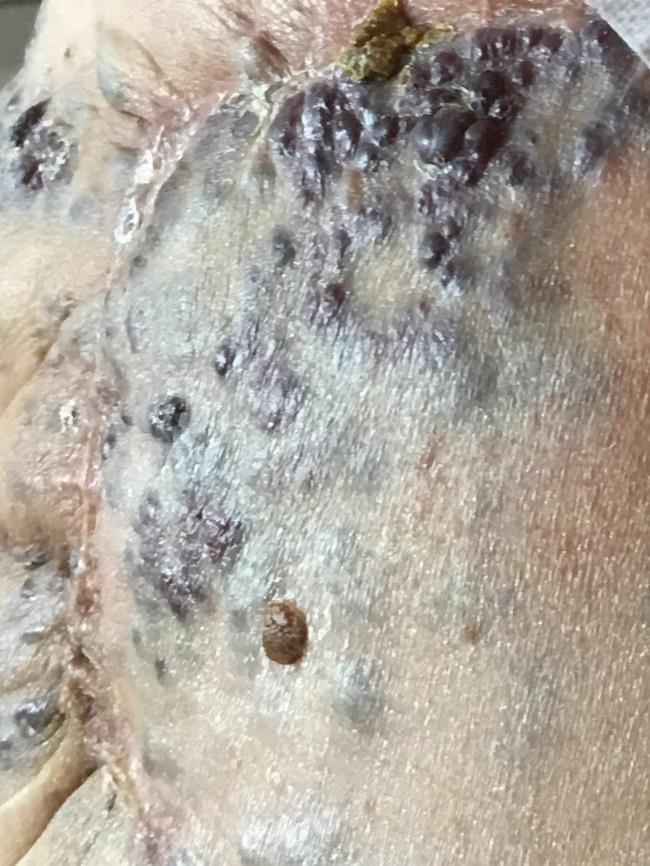 quadrantetomia + axillaris block