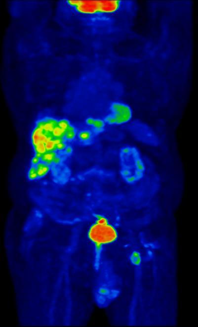 Staging: Elsődleges: rectosigm. tumor Mtpx. májen áttétek. Néhány pulmonalis csomó.
