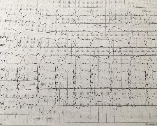 Koronarográfia: nincs szükség beavatkozásra EKG: normofrekvencia, sinus rhythm, LBBB, QRS 170 ms A kardiológus