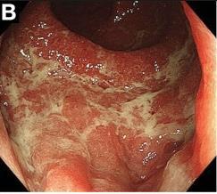 ) Tüdő: immunmediált pneumonitis, interstitialis tüdőbetegség: asymptomatic, száraz köhögés (!), dyspnoe, GGO.