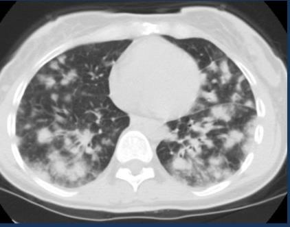 neuropathia (n.