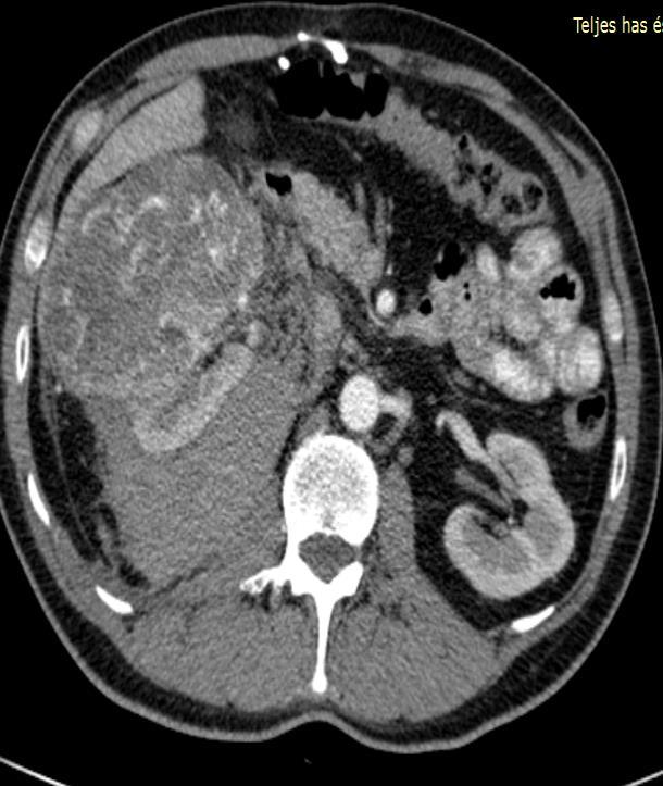 Vesesejtes daganat nivolumab kezelése 45 éves, polytrauma + splenectomia, cholelithiasis a kórelőzményben 2014.
