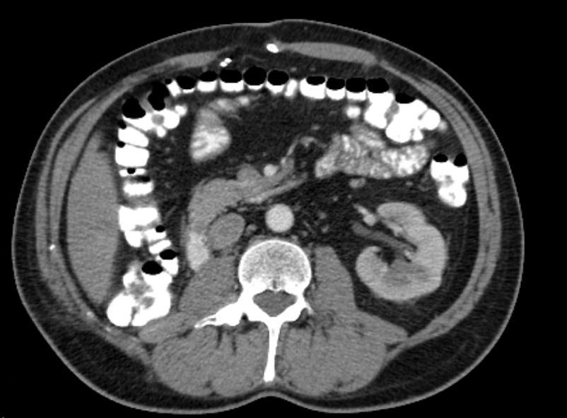 retroperotineális hematómát mutatott Radikális nefrektómia történt: 14 cm RCC, Fuhrman G3, pt2 2014.10.