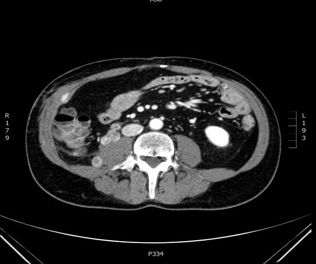 12: pseudoprogresszió (lung +