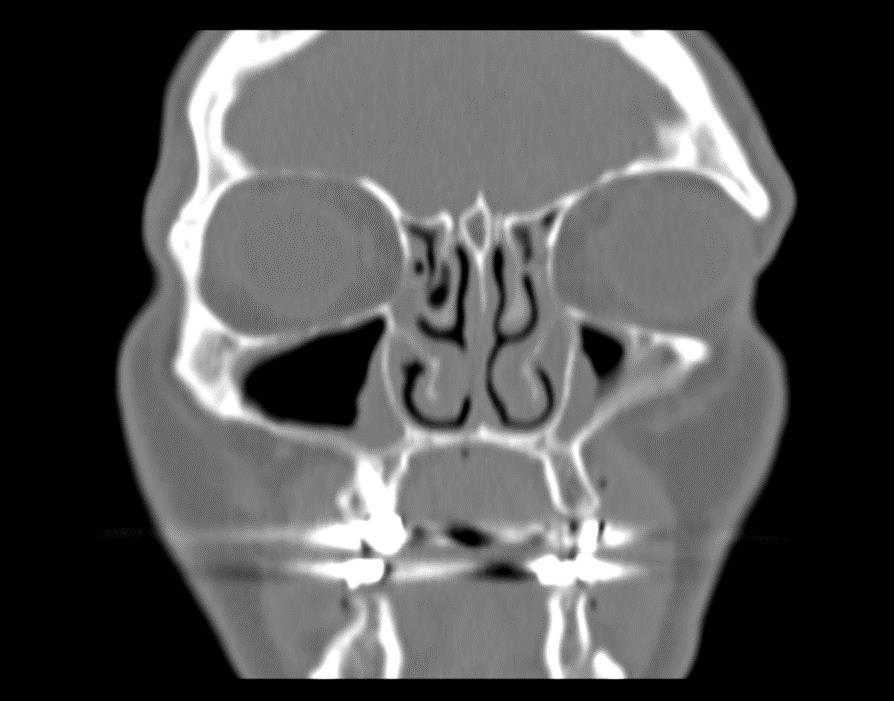 1.vonal pazopanib 2.vonal nivolumab Diagnózis RCC + met pulm 2015.07: PD: tüdő + retroperit.lgl 2015.12: pseudoprogresszió (lung + retroperit) 2016.01: stable disease 2016.