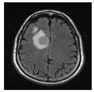 immunterápia (Ipilimumab és