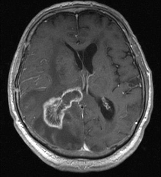 Glioblastoma Leggyakoribb glióma Primer / szekunder Rossz prognózis Műtét / biopszia Túlélés 4-7 hónap Adjuváns sugárkezelés