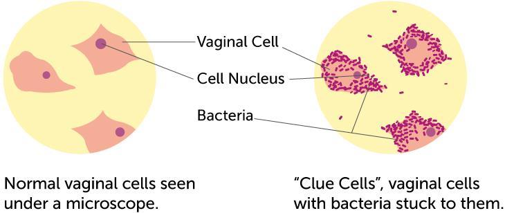 BAKTERIÁLIS VAGINOSIS Kórokozó: o a hüvelyben megemelkedik a ph o a normál flórát adó lactobacillusok