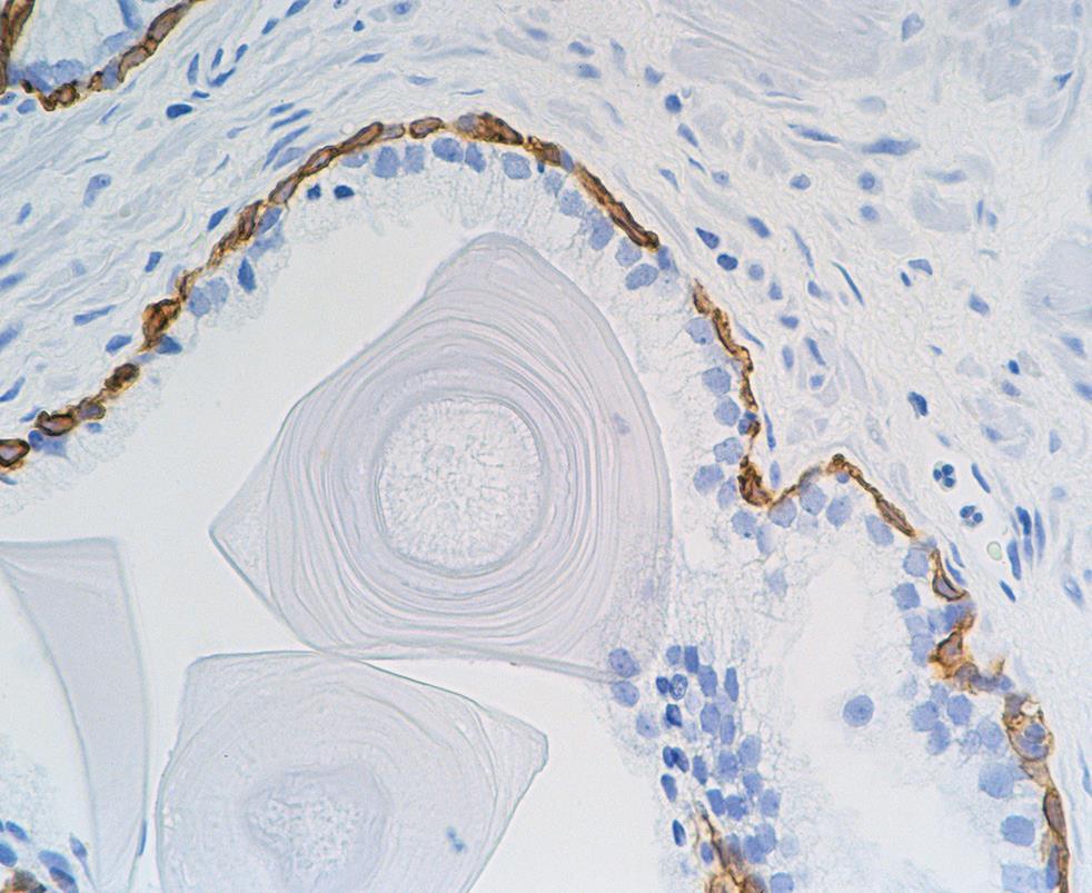 FM: hyperplasia adeno-myo-fibrosa; a felszaporodott mirigyek normális szerkezetűek Basalis