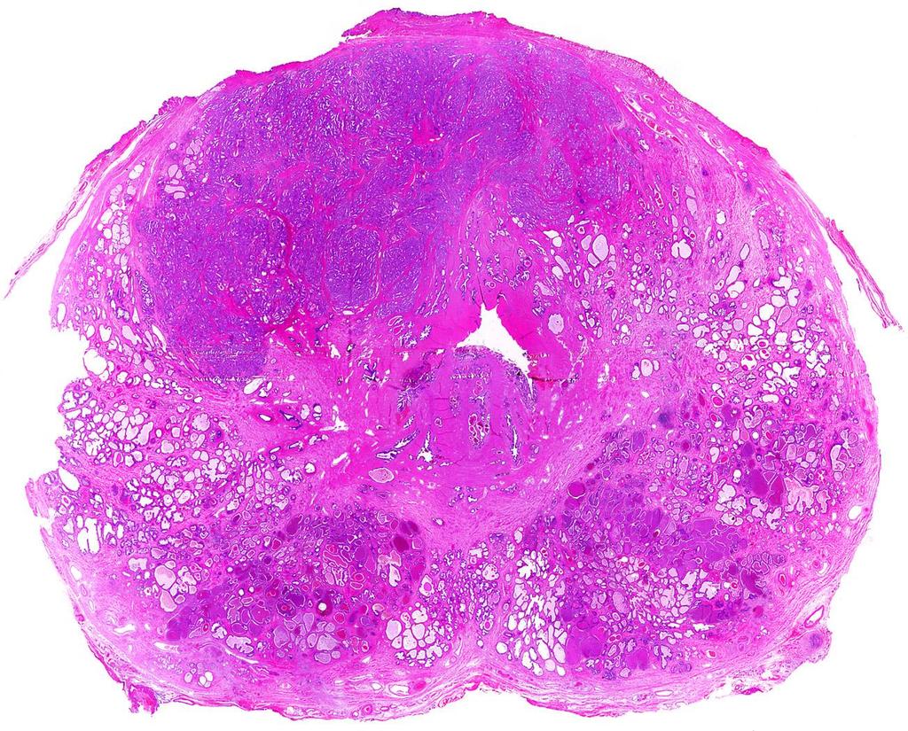 Az adenocarcinoma