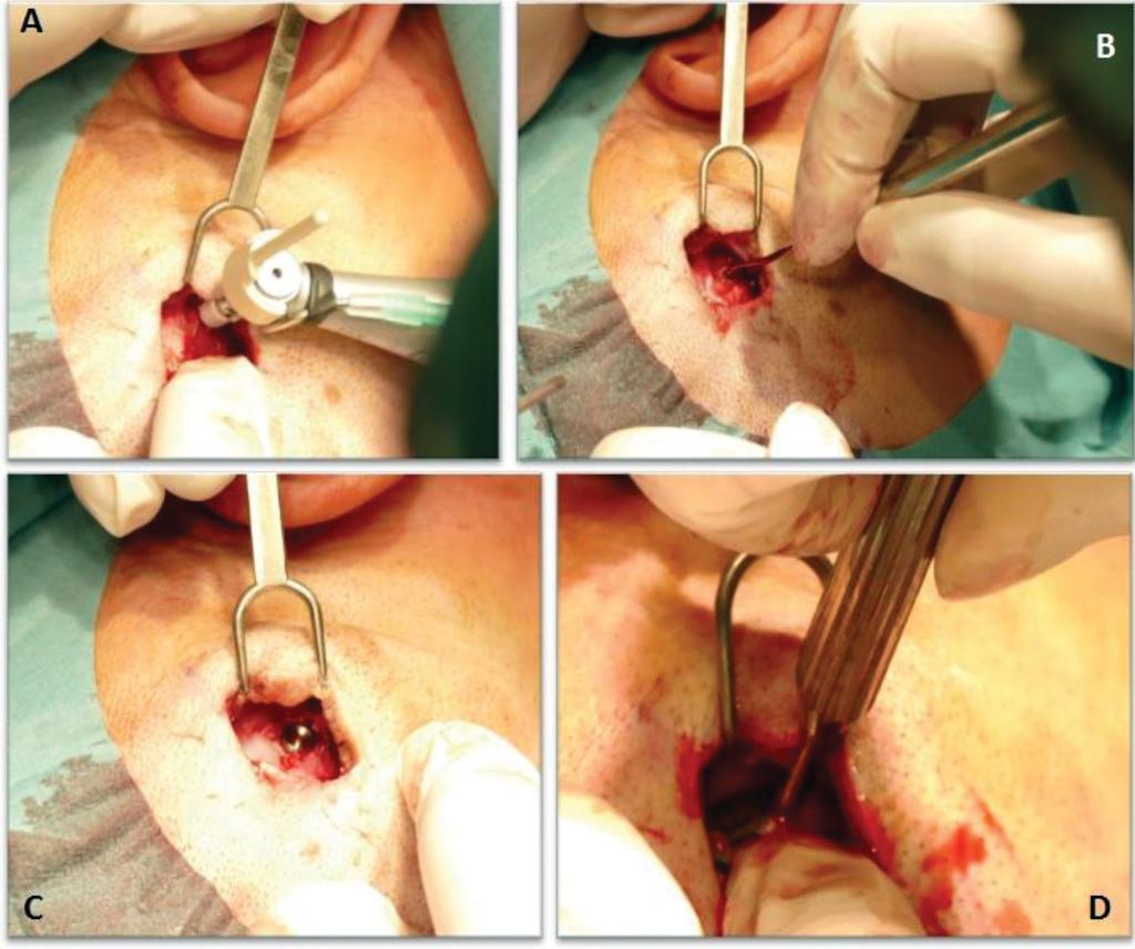 2. ábra Baha Attract implantáció műtéti képei. A) Implantátumágy kialakítása fúróval. B) A kialakított implantátumágy mélységének ellenőrzése. C) Az implantátum behelyezése.