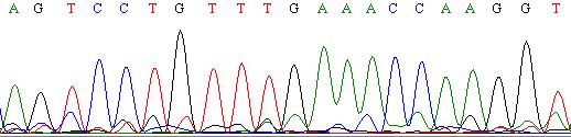 A molekuláris genetikai diagnózis eredménye Exon 5 Ser Pro Val STOP Asn Gln Gly c.748 C/T p.