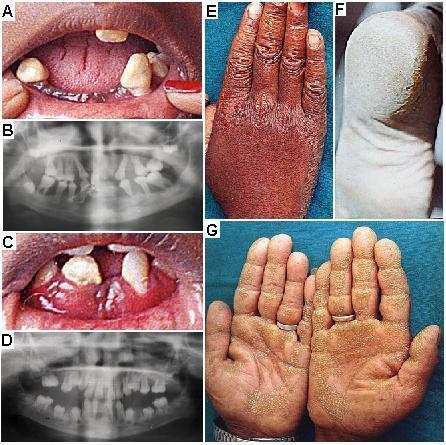 Papillon-Lefévre syndrome (PLS; OMIM 245000) Rare, autosomal recessive inheritance Palmoplantar keratoderma Severe periodontitis and