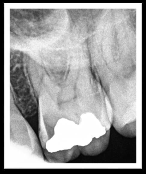 PANASZOS FOG VIZSGÁLATA (26) Inspectio: az amalgámtömés mellett secunder caries látható mesialisan