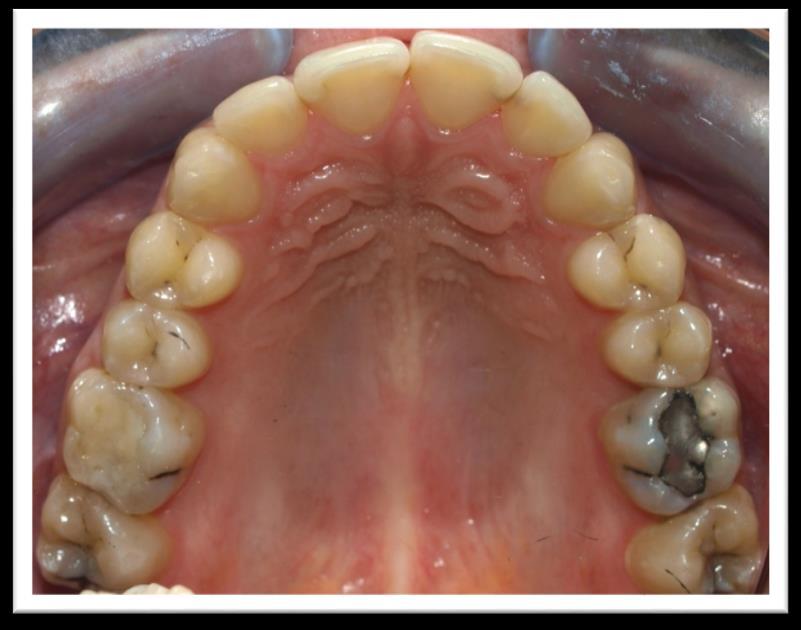 FELSŐ ÁLLCSONT DENTALIS STÁTUS KONZERVÁLÓ FOGÁSZATI STÁTUS (maxilla) Foghiány Caries Tömés Gyökértömés Betét nincs 17O, 16P, 11M, 21D, 22M, 26MO, 27OD 16MO