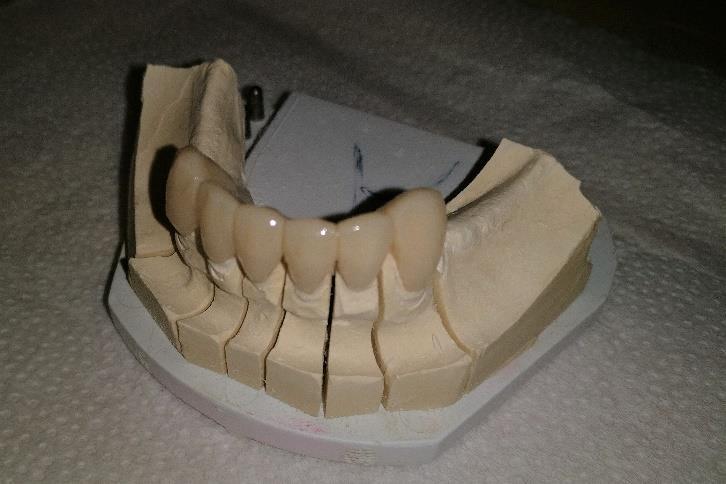 (PMMA;CAD/CAM) ideiglenes sín (horgonykoronák: 33,