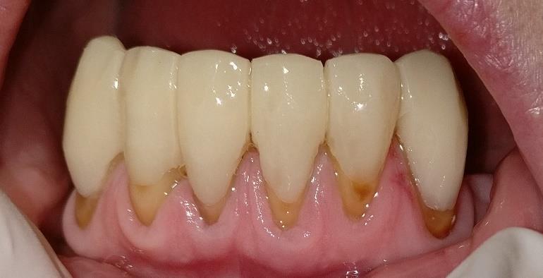 csonkvédelme (Ultradent Universal Dentin Sealant)