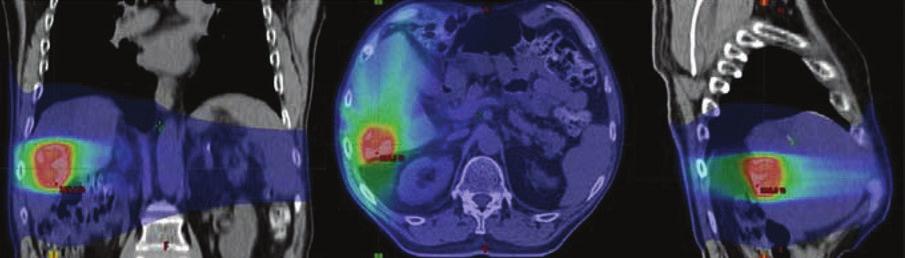 64 FÖLDI ÉS MTSAI zésekor kemoterápiára (pemetrexed-ciszplatin) jól reagáló, 6 hónapja stabil, 8 mm nagyságú bal tüdőcsúcsi góc, egy bal csípőlapáti 1 cm-es csontáttét és a máj S7-ben egy 28 mm-es