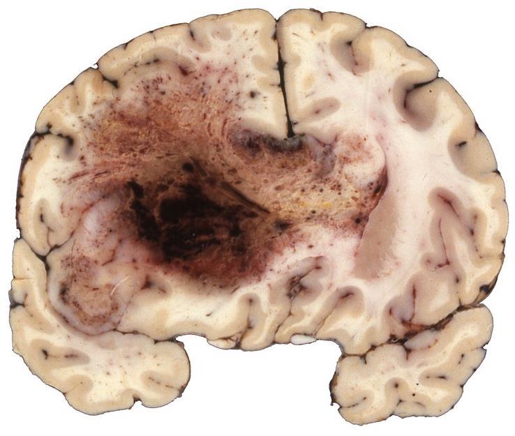 Glioblastoma- Makroszkóposan Necrosis Bevérzés Diffúz infiltrációs