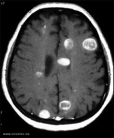 AGYÁTTÉT Gyakrabban fordulnak elő, mint a primer intracranialis malignus tumorok!